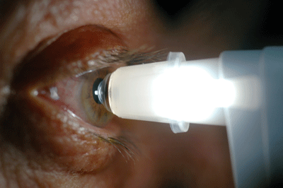 Measuring Eye Pressure (IOP)