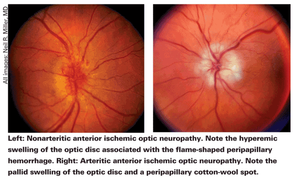 ischemic optic neuropathy