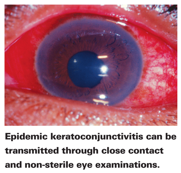 viral keratoconjunctivitis