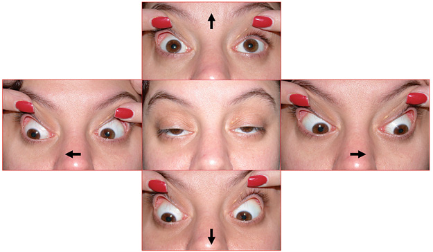 How to Spot Dangerous Ptosis—The Sequel