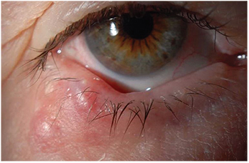 Eyelid Lesions Diagnosis And Treatment