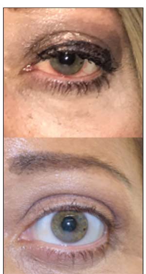 Eye bags and dark circles under eyes treatment: help reduce puffy eyes and  dark eyelids | Novuskin
