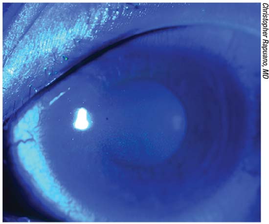 A Man's Eyes Were Stained Blue After He Took An Antibiotic To Treat  Inflammation