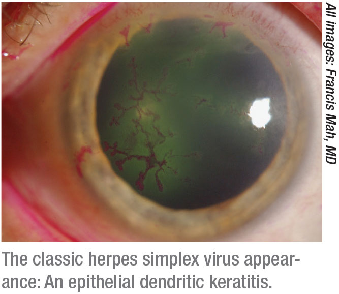 mild ocular herpes