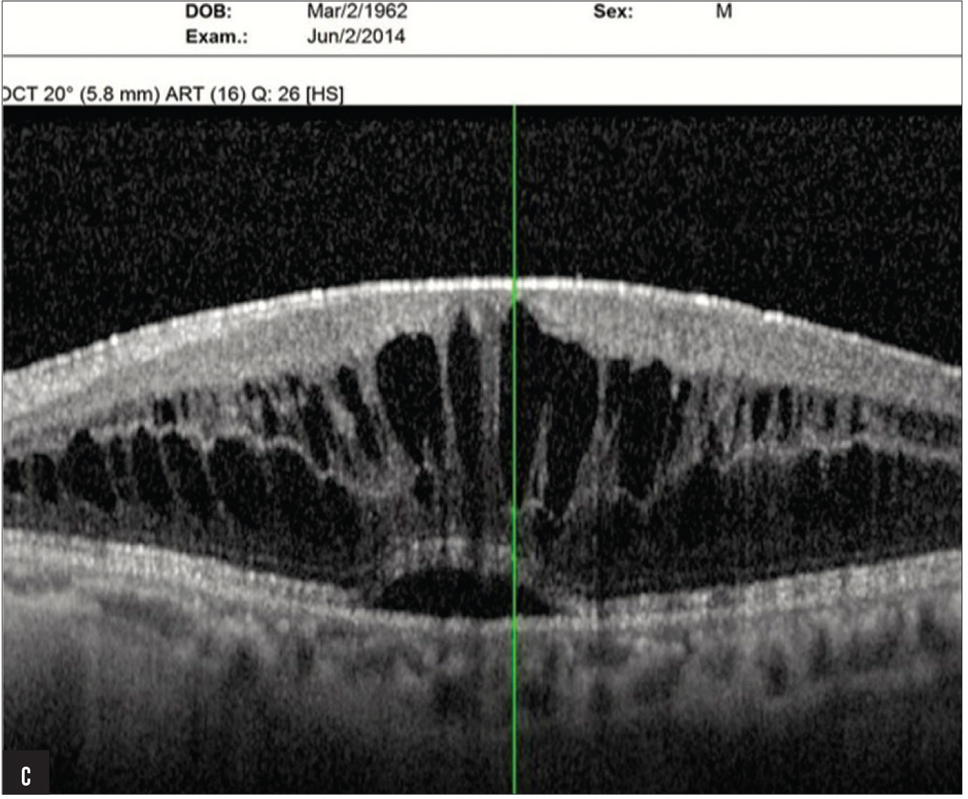 Figure 1C. The same patient (seen in Figures 1A and B) also had marked cystoid macular edema associated with the AC IOL in the left eye.