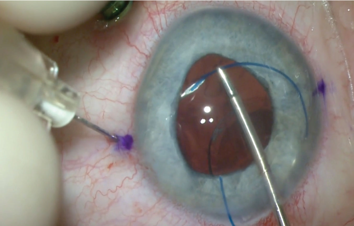 Figure 2. Intrascleral haptic fixation of a PC IOL using the Yamane technique. This technique requires familiarity with performing pars plana vitrectomy and creating scleral tunnels with a wide-bore, thin-walled, 30-gauge needle.