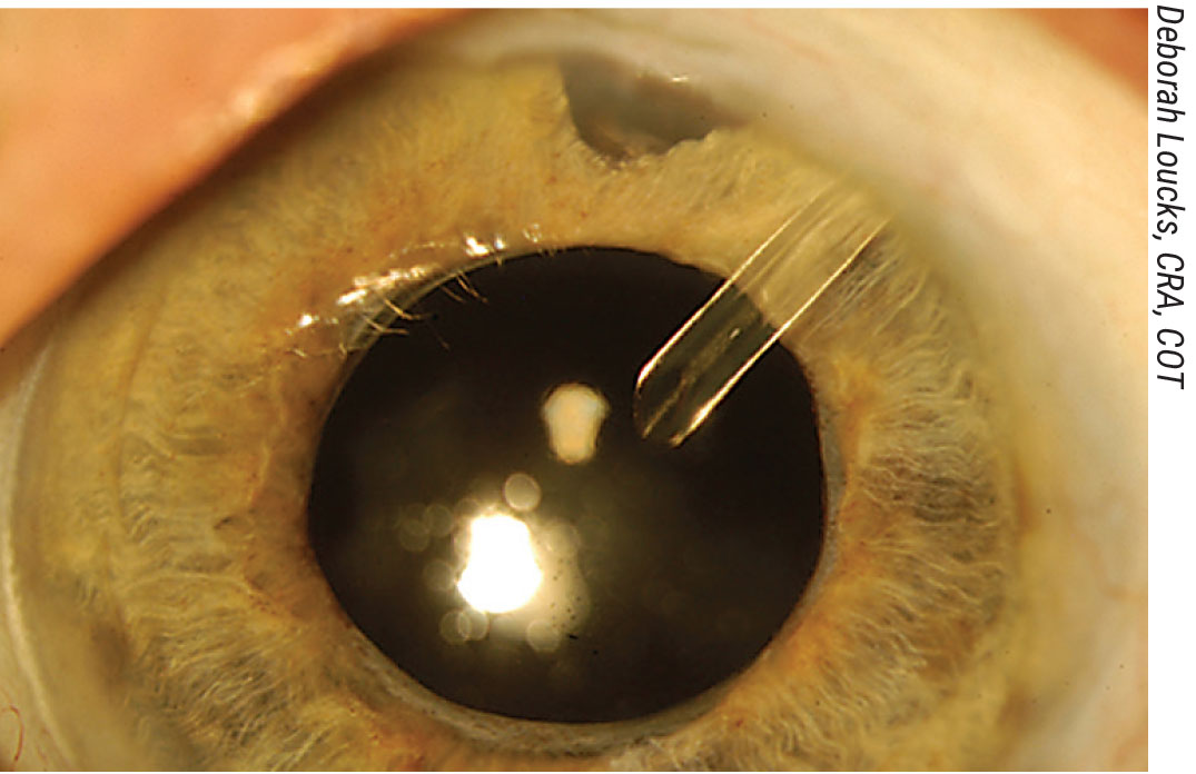 Figure 1. The postop view of a uveitic glaucoma patient who has undergone a phacoemulsification procedure combined with an Ahmed valve placement, corneal patch graft and sub-Tenon’s Kenalog treatment.