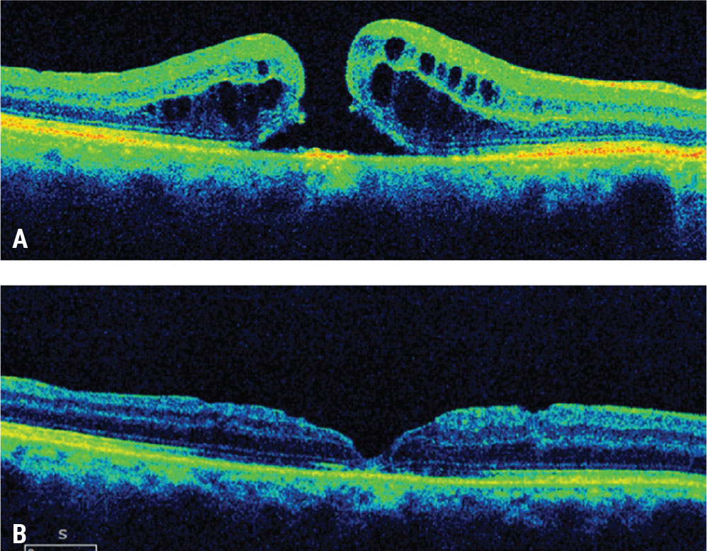Figure 1. Wider inner limiting membrane peeling for a refractory macular hole. This patient presented with a visual acuity of 20/100 a month after failed initial macular hole surgery with ILM peeling  (A). A subsequent wider ILM peel was performed with repeat gas tamponade. The macular hole closed with visual acuity improving to 20/30 (B).