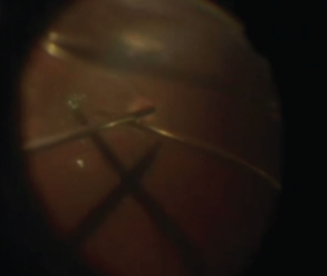 Figure 6. Bimanual technique for holding a free ILM flap in place. Chandelier illumination facilitates the bimanual technique of holding the ILM free flap over the macular hole  during fluid-air exchange (see partial air fill at the top of the image).