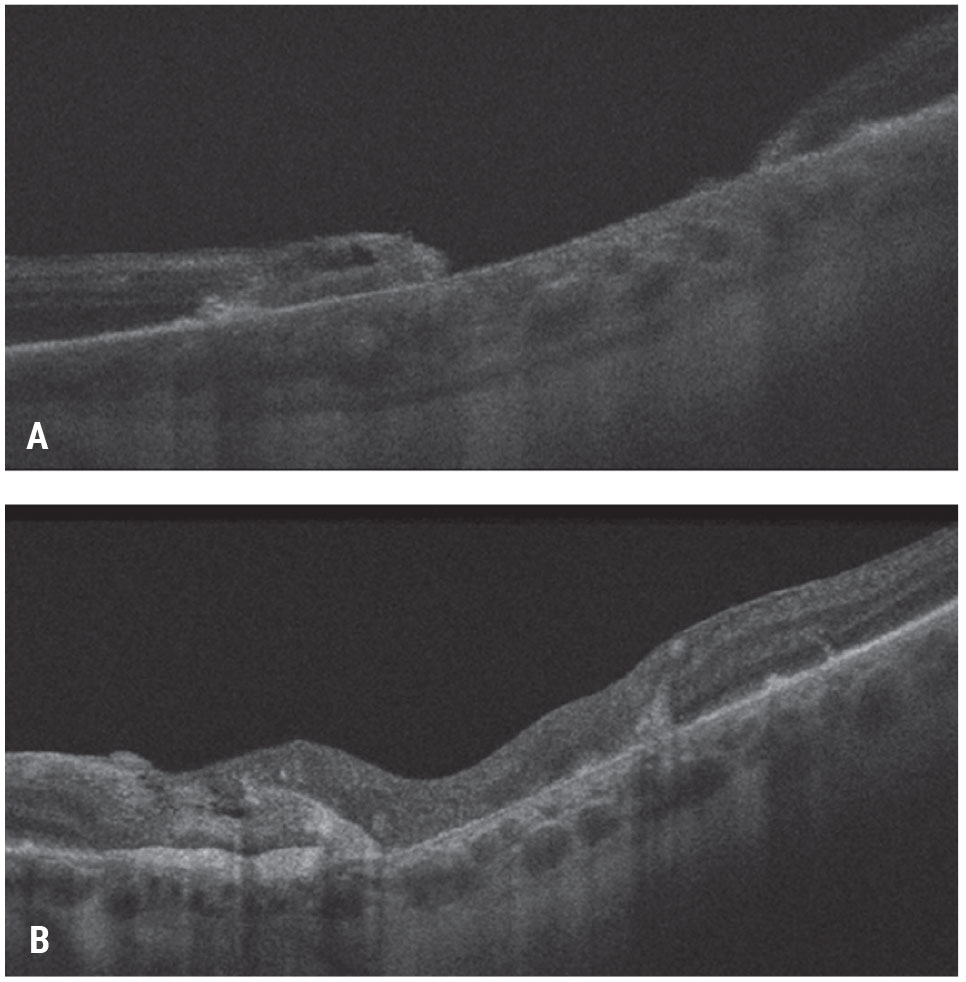 Figure 7. Autologous neurosensory retinal transplant for a large traumatic macular hole. This patient had a large traumatic macular hole with underlying choroidal atrophy secondary to an intraocular foreign body in the macula and count-finger vision (A). The patient underwent vitrectomy, inner limiting membrane peeling, autologous retina transplant into the macular hole, silicone oil tamponade for three months and silicone oil removal. The patient’s hole closed with visual acuity improving to 20/200-1 (B).