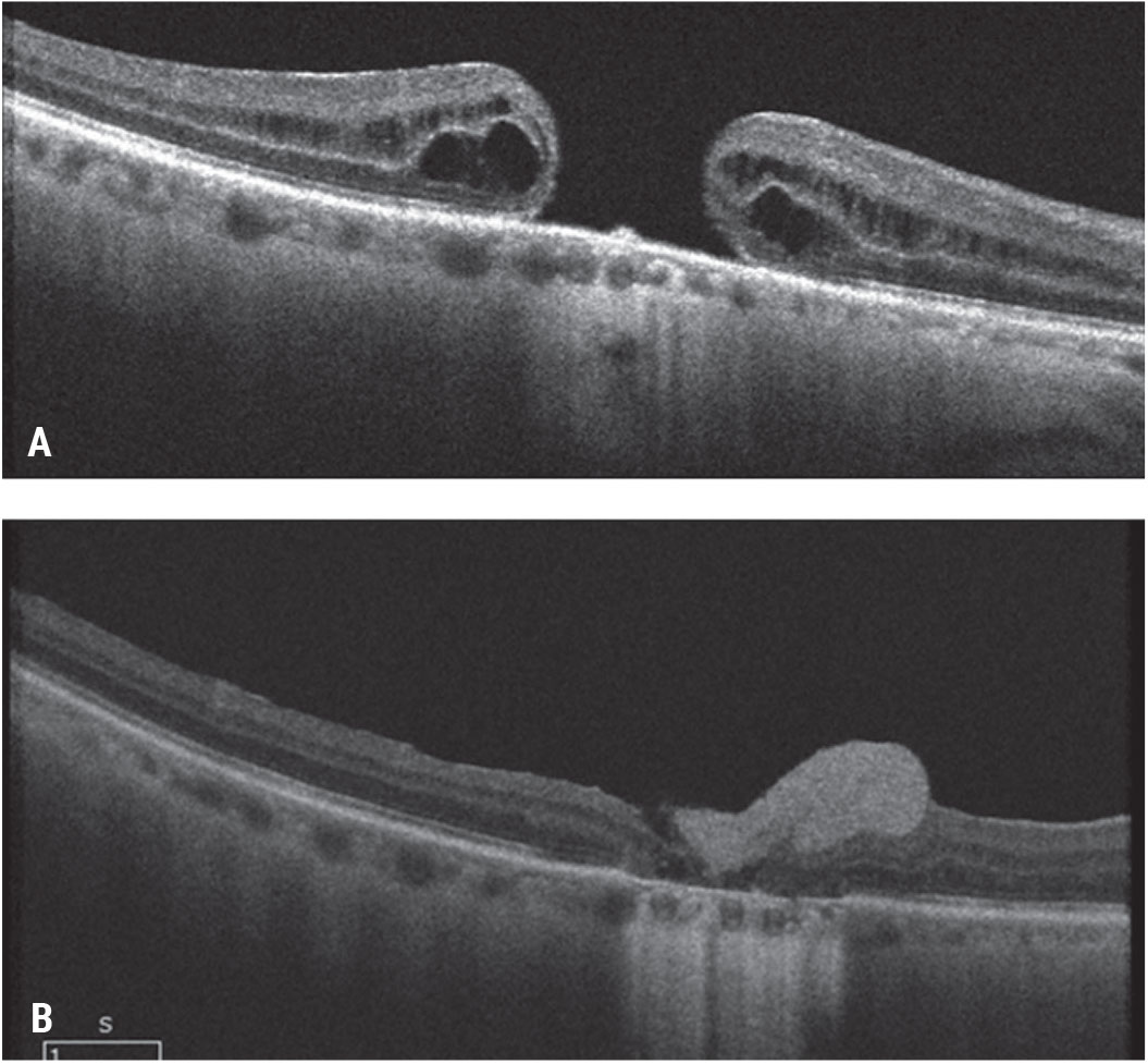 Figure 8. Pre-retinal human amniotic membrane for a chronic, large macular hole. A patient presented with a chronic macular hole of more than two years’ duration after a prior retinal detachment repair and count fingers vision (A). He underwent vitrectomy, ILM peeling and pre-retinal placement of human amniotic membrane over the macular hole and gas tamponade. As the amniotic membrane dissolved (hyperreflective preretinal material), the hole closed and the visual acuity improved to 20/150 (B). 