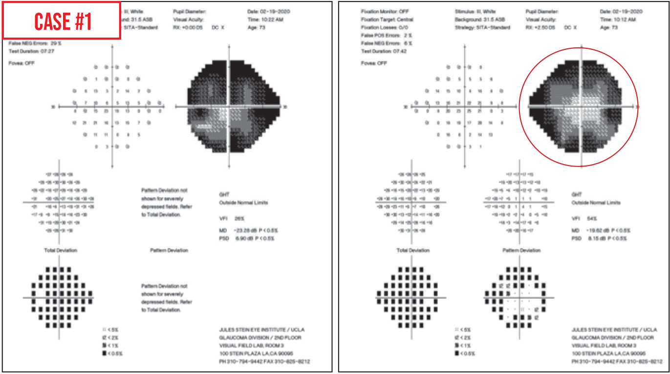 glaucoma vision loss pattern