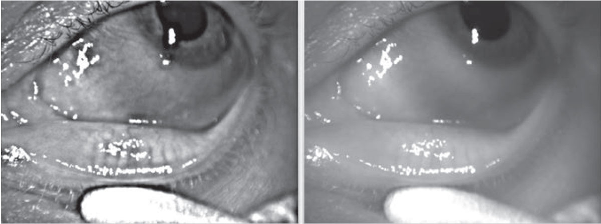Preoperative imaging of the meibomian gland shows truncated glands corresponding to a lipid deficiency in the tear film of this patient. This is just one more condition to consider when identifying and addressing factors that can prevent you from achieving the best possible cataract surgery outcomes. 