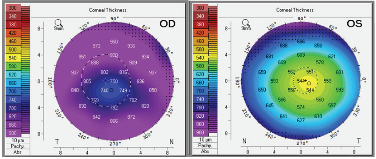 Figure 2. Corneal thickness by Pentacam of right and left eyes on day of presentation.