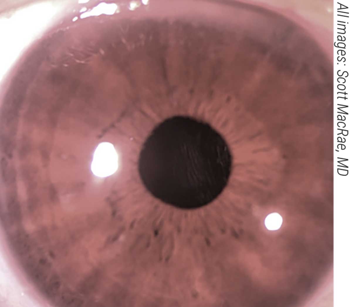1/16 Ever wonder why Wilson disease causes Kayser-Fleischer rings to form  in the cornea? Let's explore the history, mechanism, and implications of -  Thread from Avraham Z. Cooper, MD @AvrahamCooperMD - Rattibha