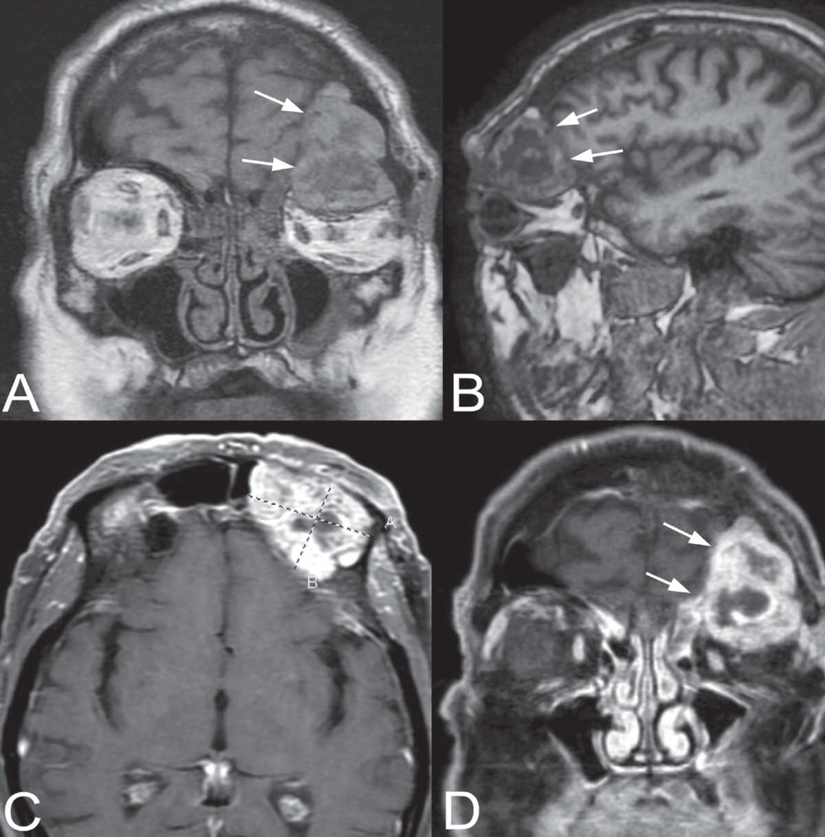 Figure 2. MR imaging. Coronal (A) and parasagittal (B) T1-weighted, pre-contrast views of the left skull base mass (arrows). Note the heterogenous signal within the mass. Axial (C) and coronal (D) T1-weighted, post-contrast views with fat suppression. The mass enhances with contrast, but contains multiple lucencies suggestive of degenerated or necrotic tumor.