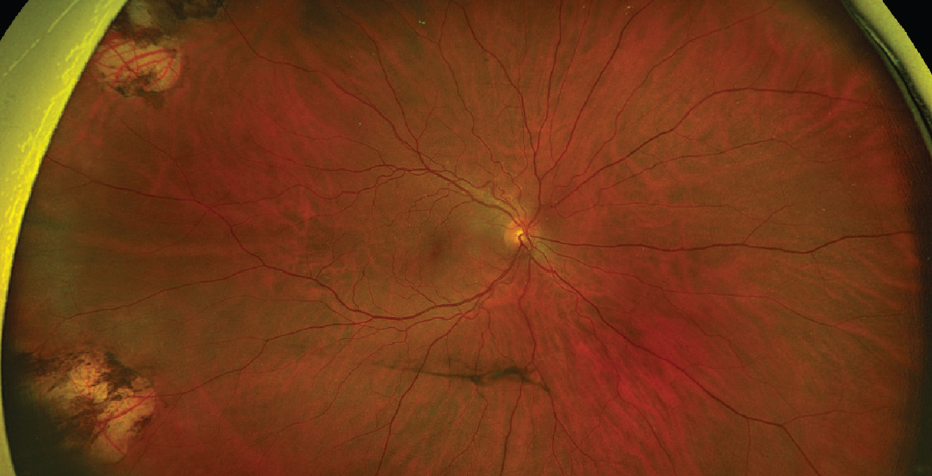 Incidental bilateral optic nerve hypoplasia
