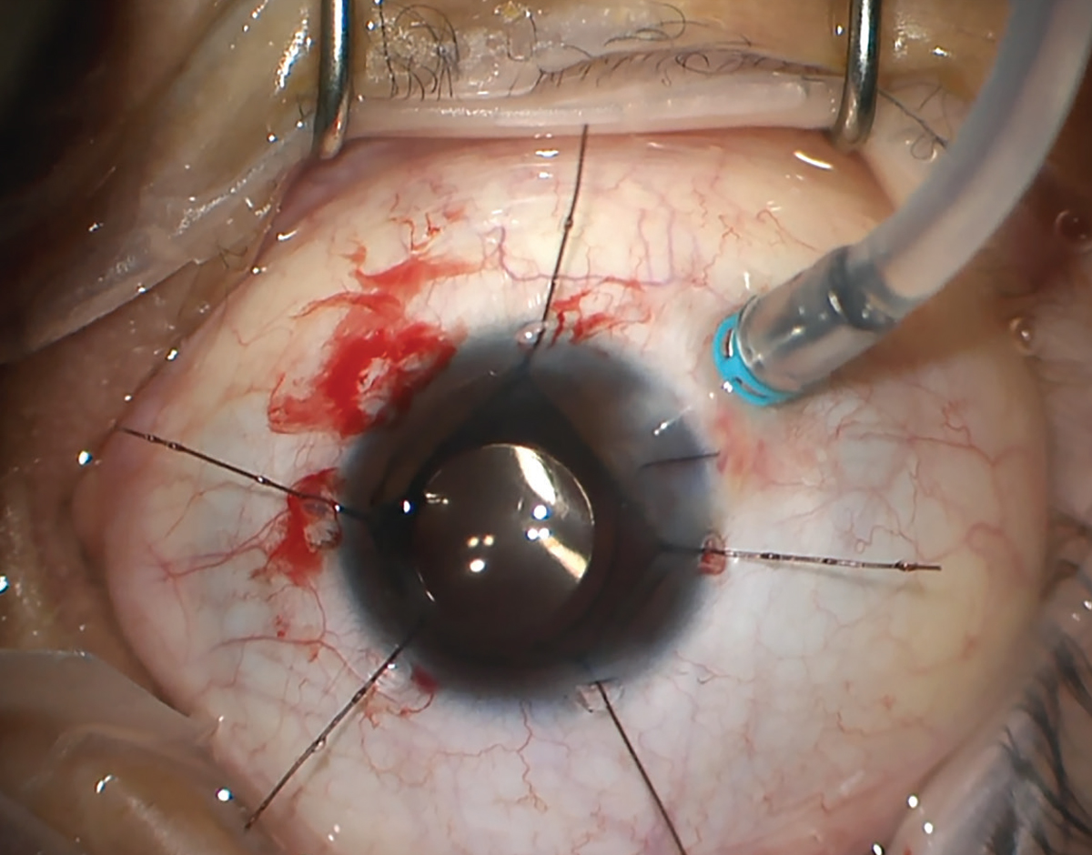 detached retina after cataract surgery