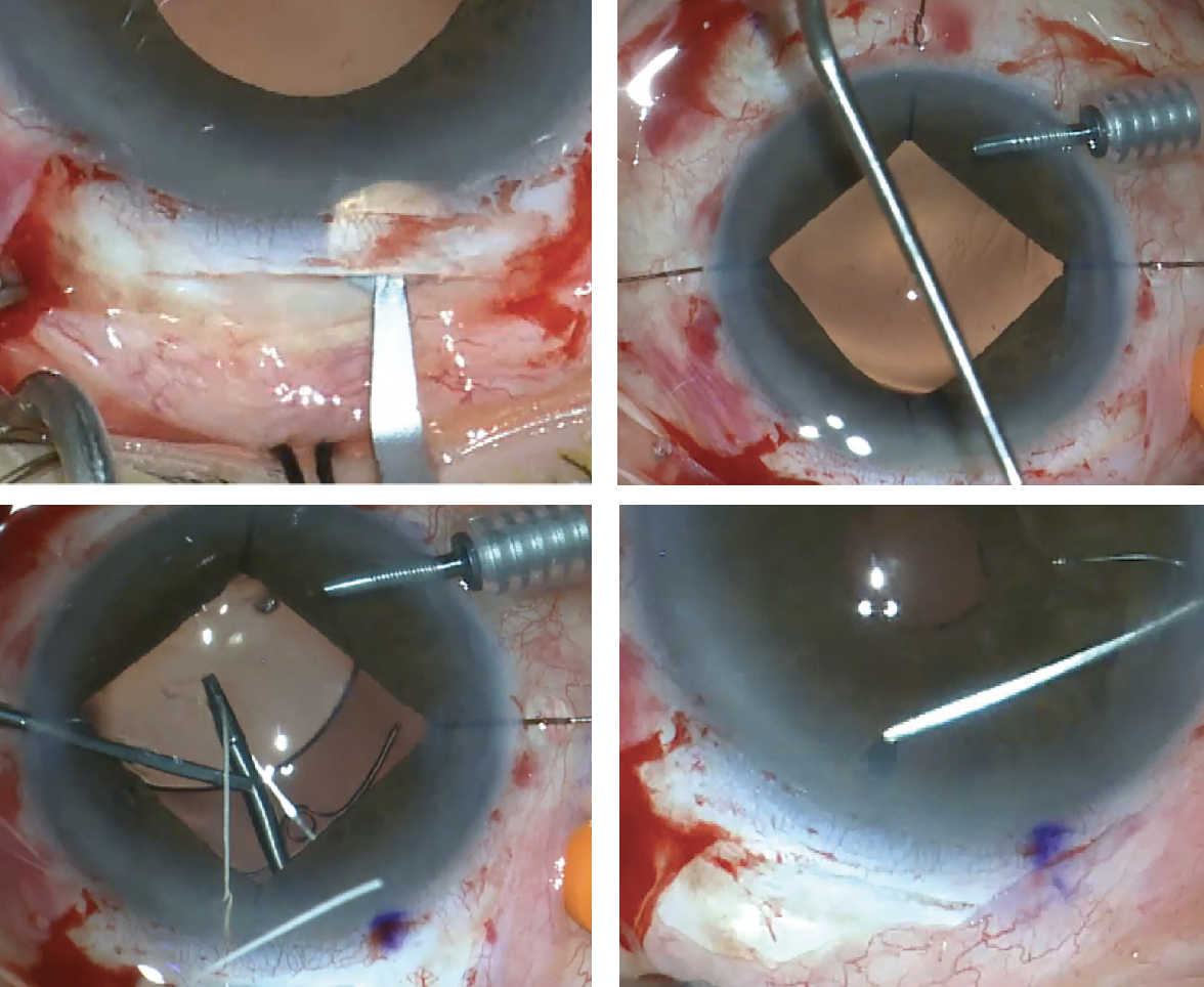 Four-flanged polypropylene optic piercing technique for scleral fixation of  multifocal intraocular lens | BMC Ophthalmology | Full Text